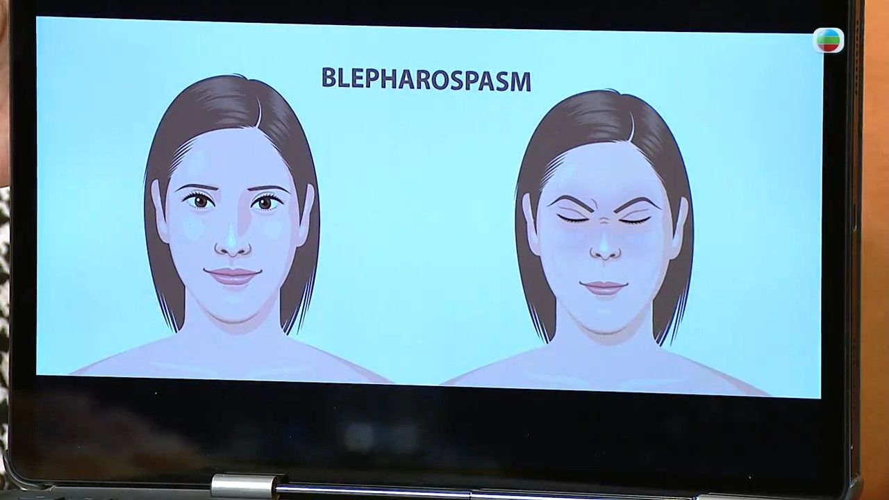 眼眉跳小心是眼臉痙攣/半面痙攣！拆解眼眉跳6大成因 醫生教4方法改善眼皮狂跳