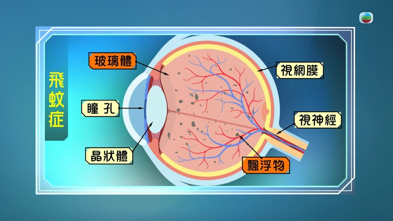 飛蚊症是視網膜脫落警號？飛蚊症3大高危人士要注意 營養師推介3類食物日常護眼