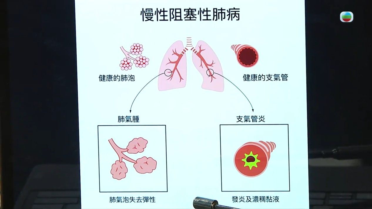 慢阻肺病｜專科醫生揭慢阻肺病7大成因 長期咳嗽＋多痰要注意！一文睇晒徵狀/治療/預防方法