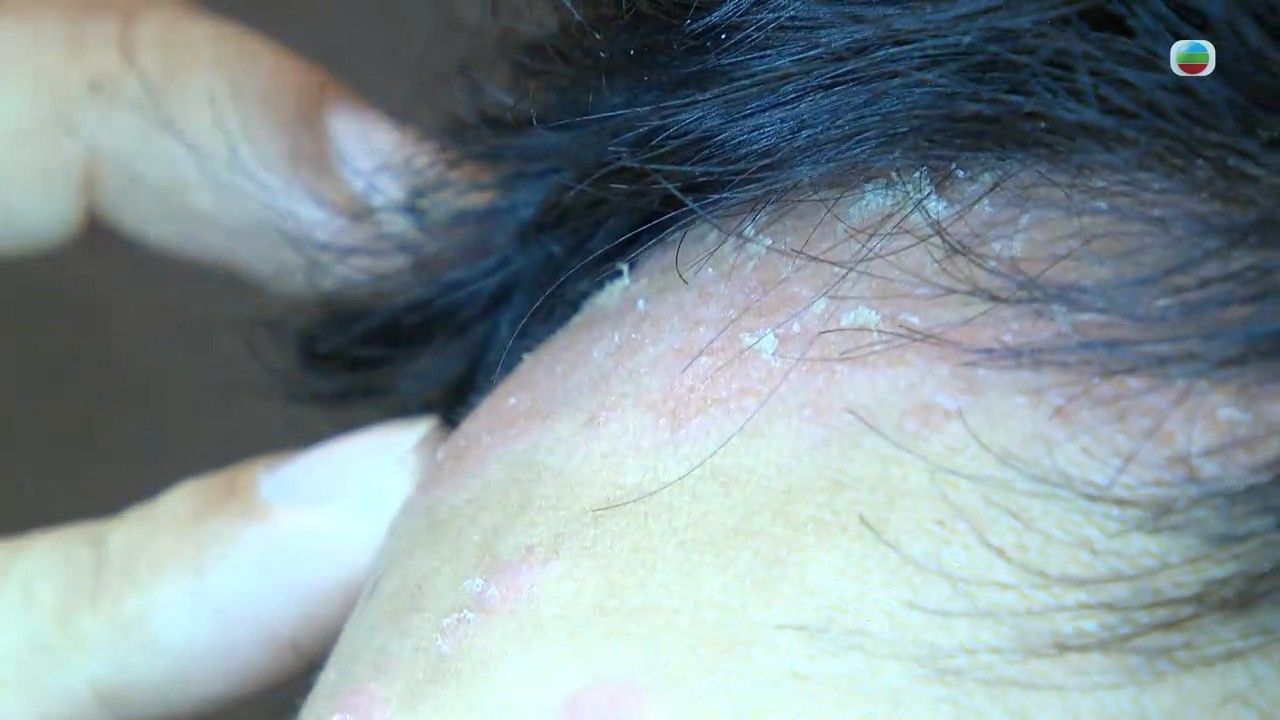 牛皮癬｜專科醫生拆解銀屑病4大成因 處理不當會變關節病！3種方法紓緩牛皮癬