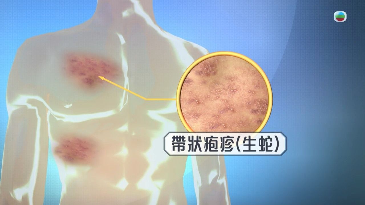 生蛇症狀｜最嚴重可失明！少女生蛇致漏口兼面癱 生蛇人士應攝取6大營養