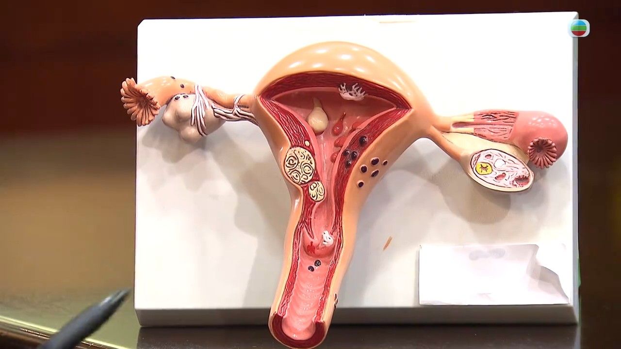 子宮頸癌｜啡色分泌物是子宮頸癌徵狀？專家揭4種人士超高危！即睇2大預防方法