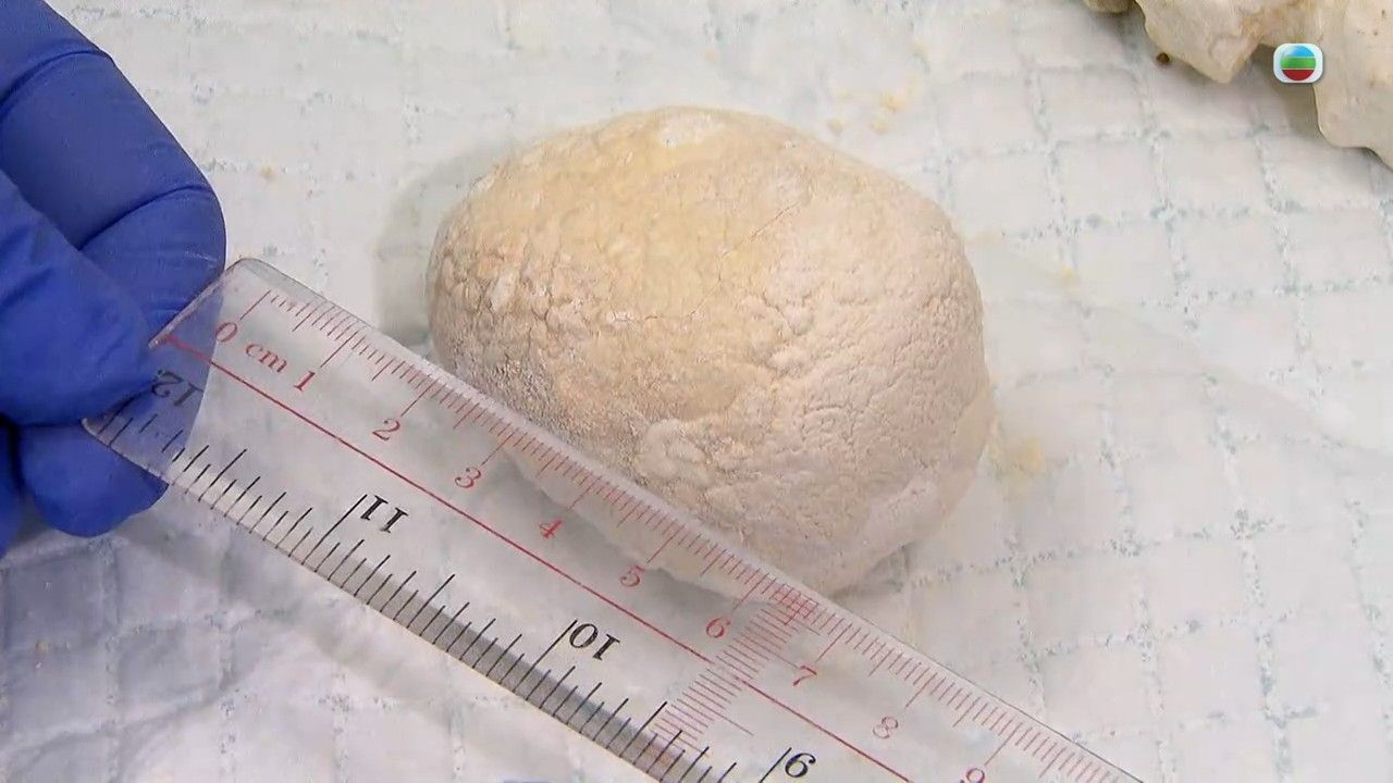 腎結石｜飲奶茶會生腎石？5種人士屬高風險 腰後痠軟要注意！推介1款茶飲利尿消腫