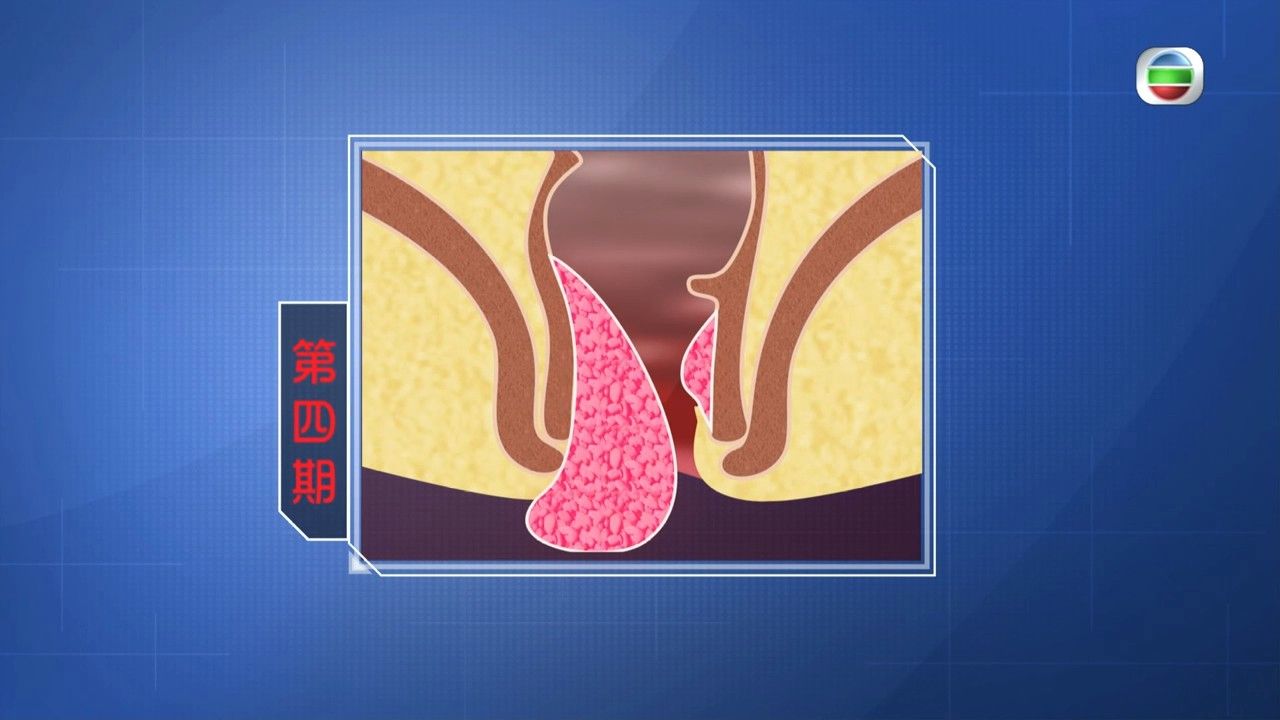 痔瘡｜長期坐著增患痔瘡風險？預防痔瘡5大飲食方法 營養師推介1款小食助排便
