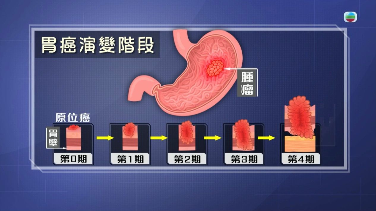 胃癌｜胃部不適、體重驟降小心是胃癌 醫生揭3大高危人士 胃部切除後5大注意點