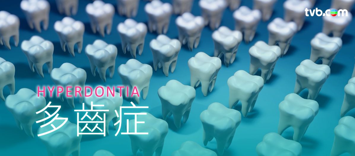 牙齒｜11歲女童患「怪病」 照X光現81隻牙 ！專科醫生解釋多生齒4大問題