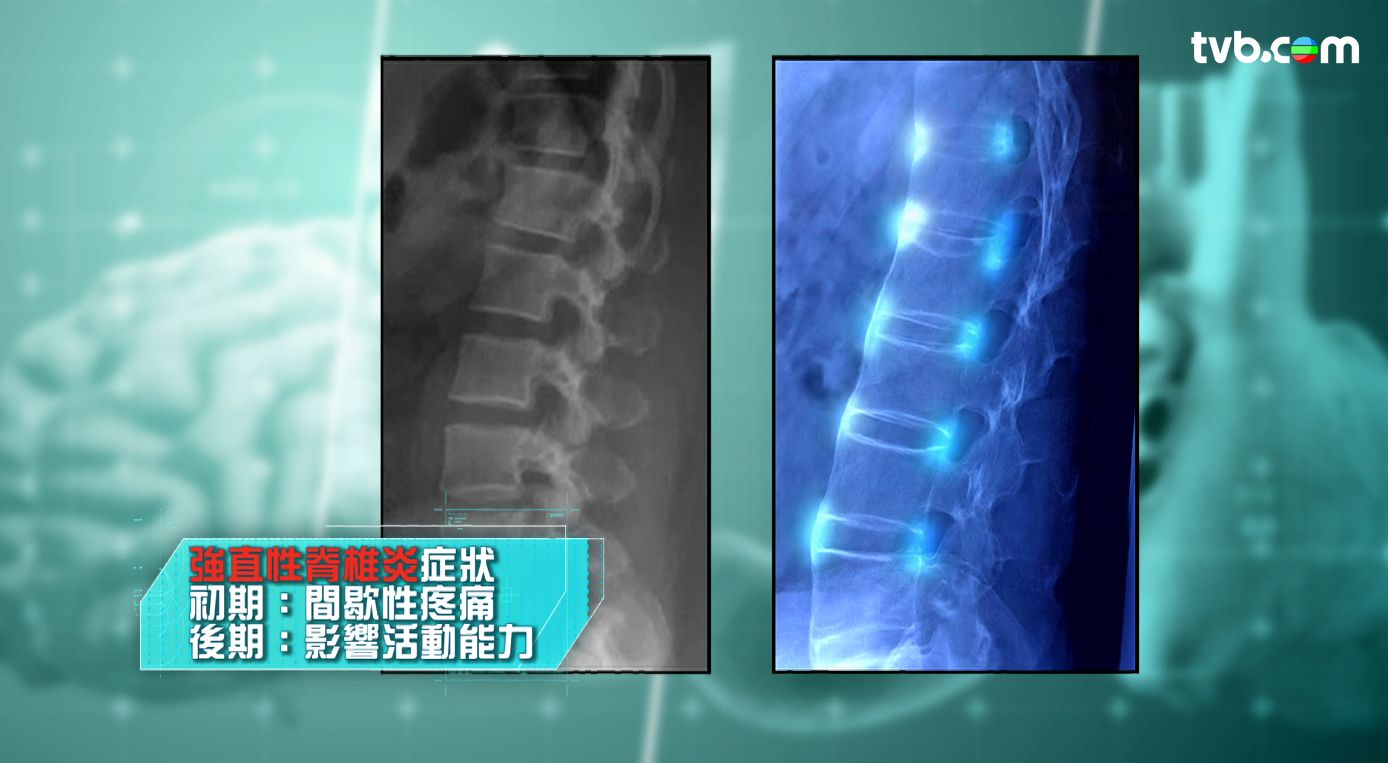 風濕病｜周杰倫患強直性脊椎炎 曾要媽媽代穿襪！專家拆解初期＋後期症狀！2大測試自我檢測