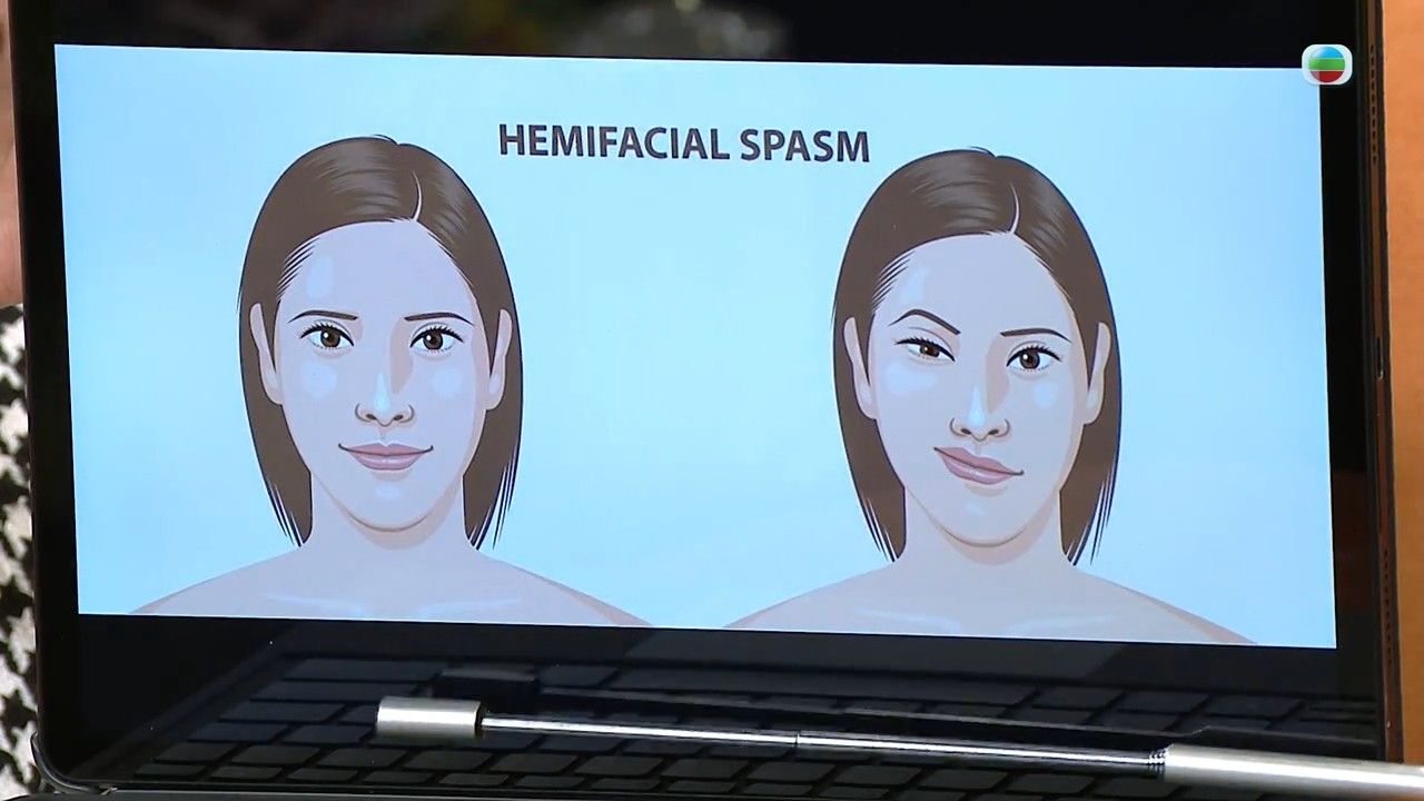 眼眉跳小心是眼臉痙攣/半面痙攣！拆解眼眉跳6大成因 醫生教4方法改善眼皮狂跳