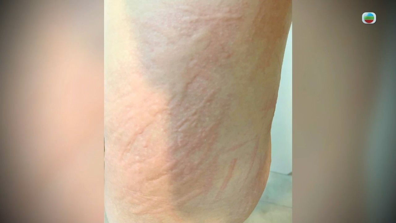 風癩｜醫生解構3種人較易患上蕁麻疹！一文睇晒蕁麻疹成因/治療方法/飲食建議