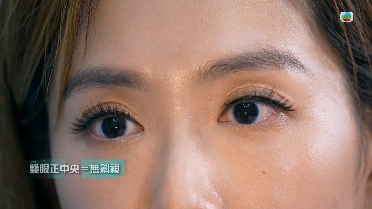 斜視｜長期玩手機致鬥雞眼？專家揭斜視2大徵狀＋簡易自測方法