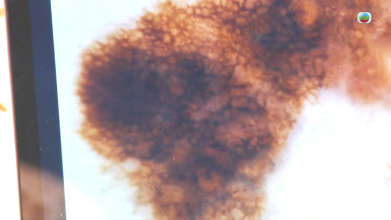 皮膚癌｜ 癦痣現4情況要留意！醫生揭皮膚癌2大成因/黑色素瘤常見位置