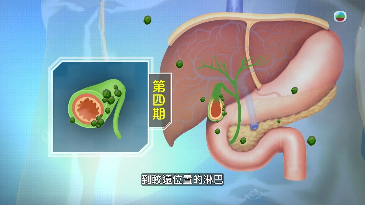 膽囊癌｜上腹不舒服小心是膽囊癌！醫生揭早期5大病徵似生膽石 即睇病因/高危人士/治療方法