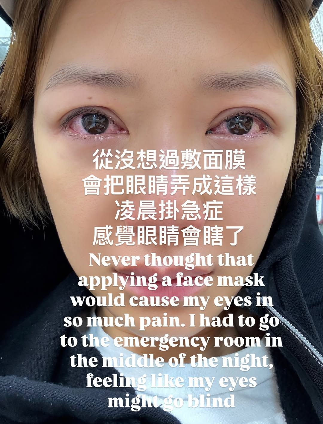 敷面膜｜倪晨曦敷面膜雙眼劇痛入急症！眼科醫生揭一種物質入眼可致失明