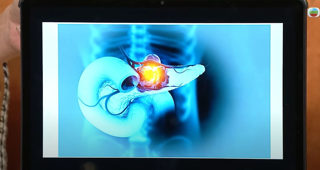 胰臟癌｜醫生分析「癌中之王」胰臟癌4大高危因素 帶一種基因易出事 5大行為減患癌風險