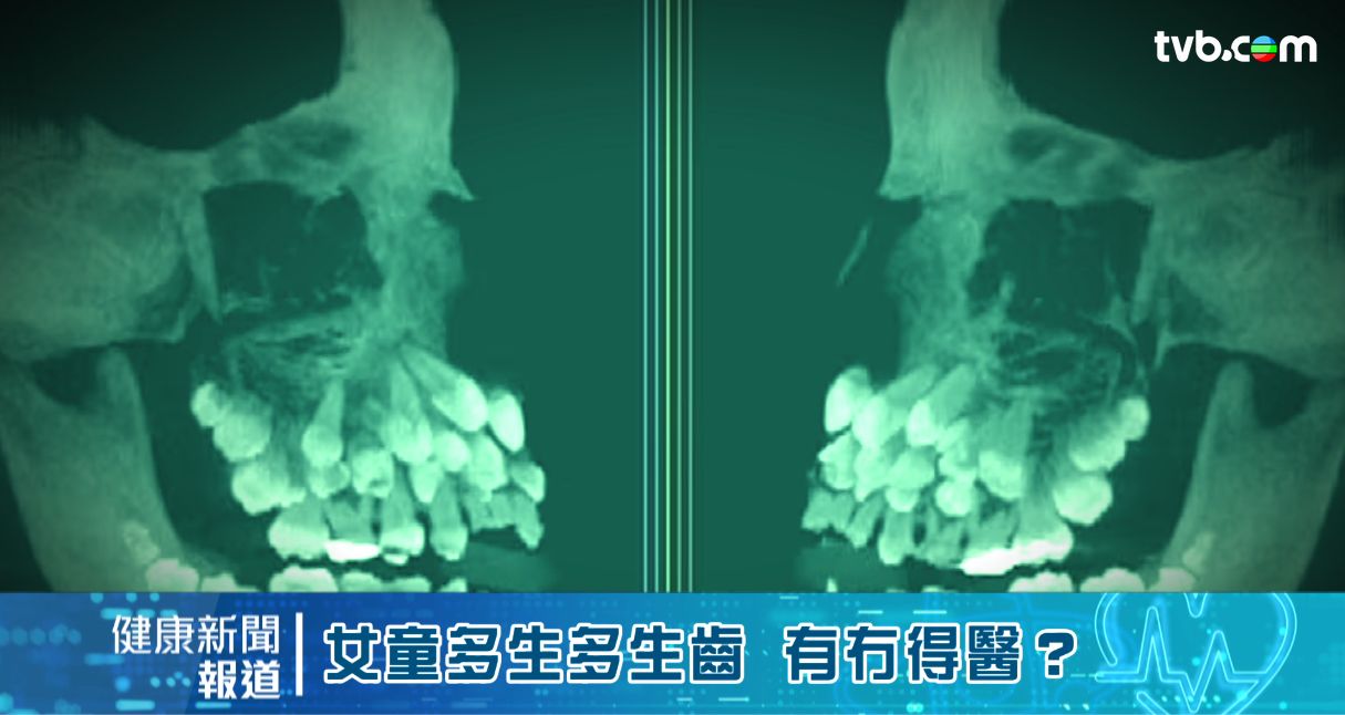 牙齒｜11歲女童患「怪病」 照X光現81隻牙 ！專科醫生解釋多生齒4大問題
