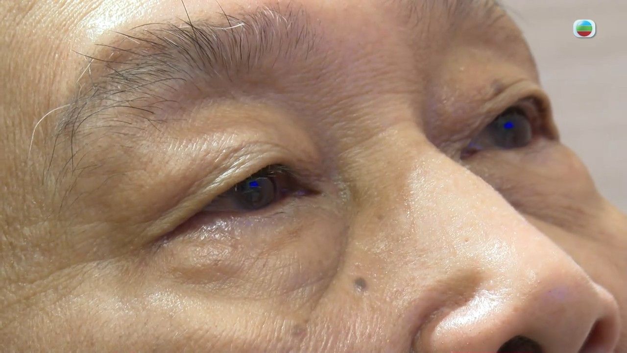 白內障｜視力模糊小心白內障！醫生警告嚴重可致2大眼疾 即睇治療方法/中醫穴位按摩