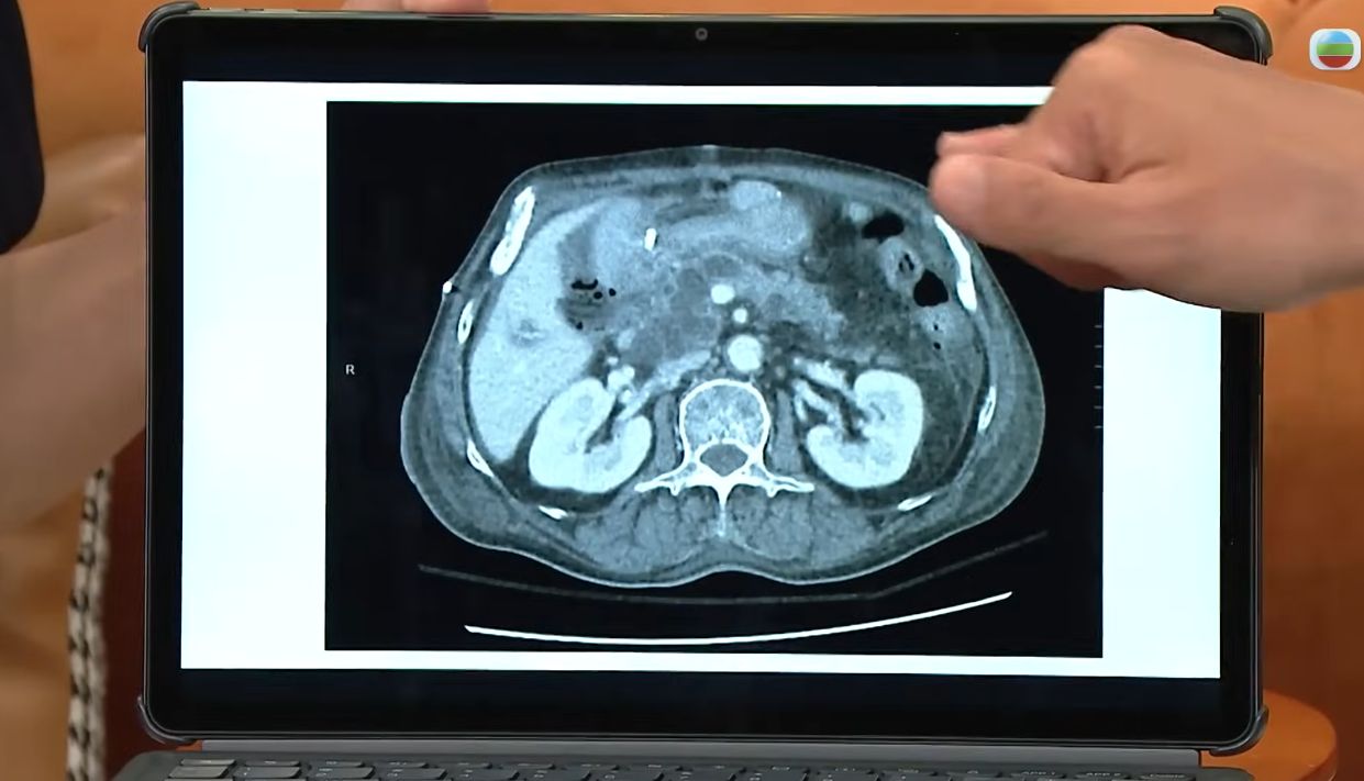 胰臟癌｜醫生分析「癌中之王」胰臟癌4大高危因素 帶一種基因易出事 5大行為減患癌風險