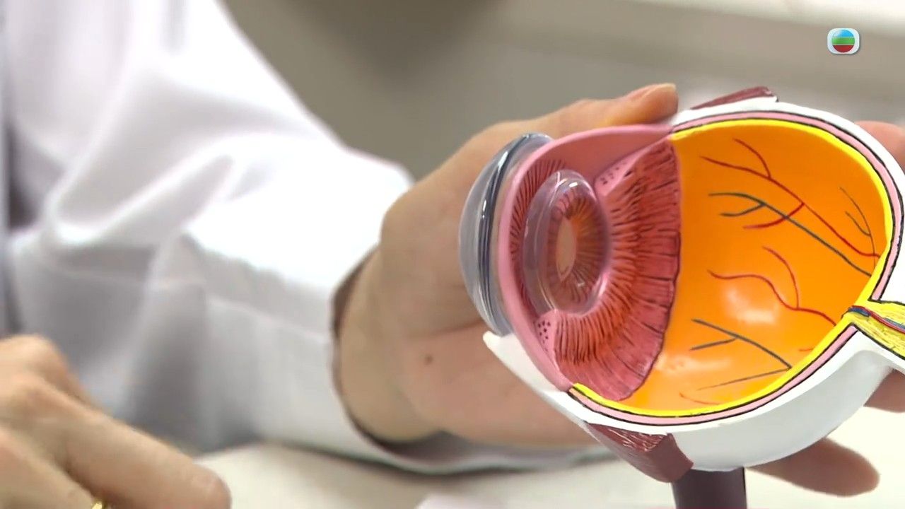 白內障｜視力模糊小心白內障！醫生警告嚴重可致2大眼疾 即睇治療方法/中醫穴位按摩