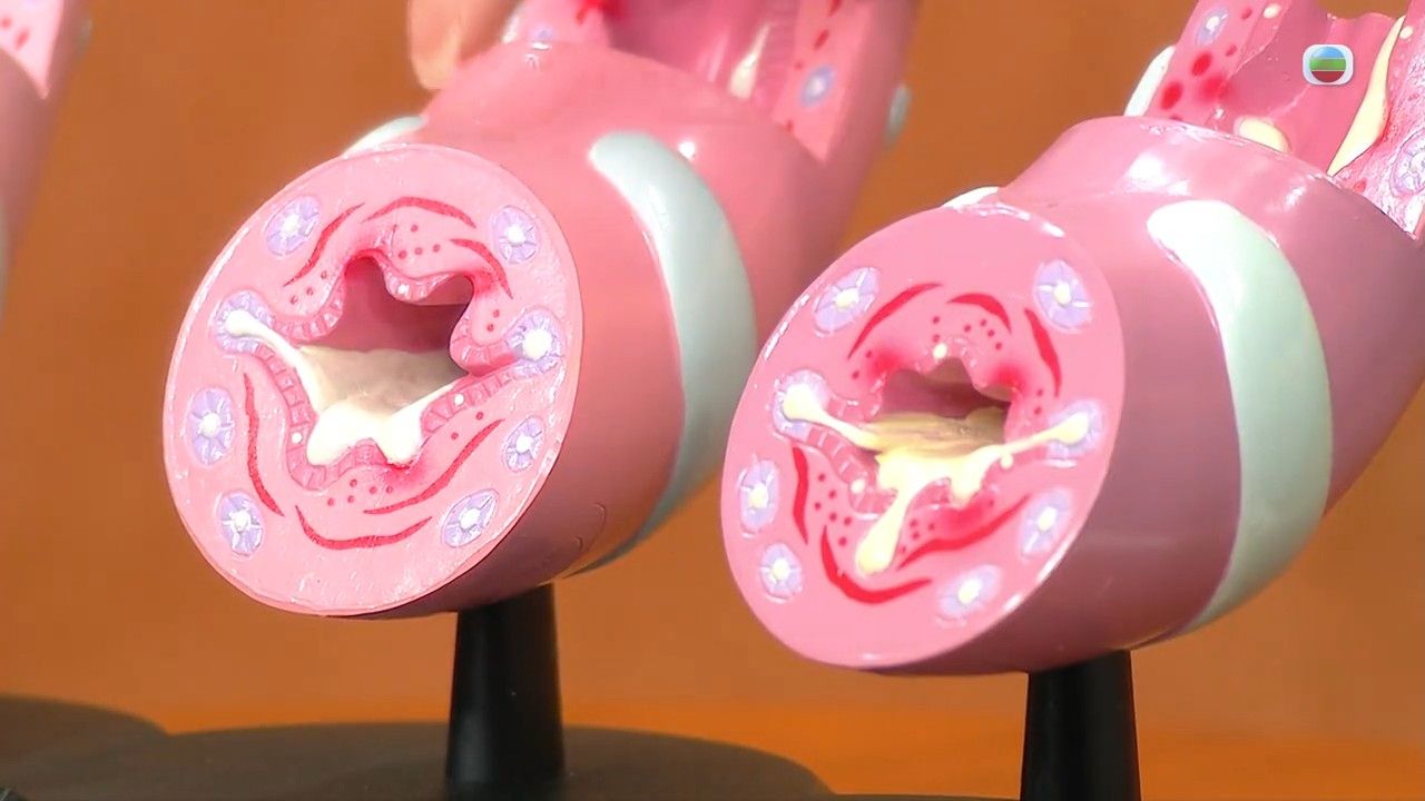 哮喘｜夏天是哮喘高危季節？醫生警告切忌做一件事！3個貼士防夏日哮喘發作+患者運動3大注意位