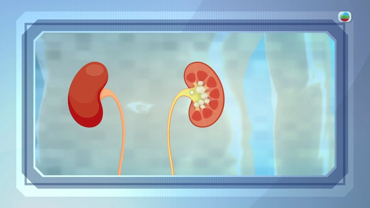 腎結石｜飲奶茶會生腎石？5種人士屬高風險 腰後痠軟要注意！推介1款茶飲利尿消腫