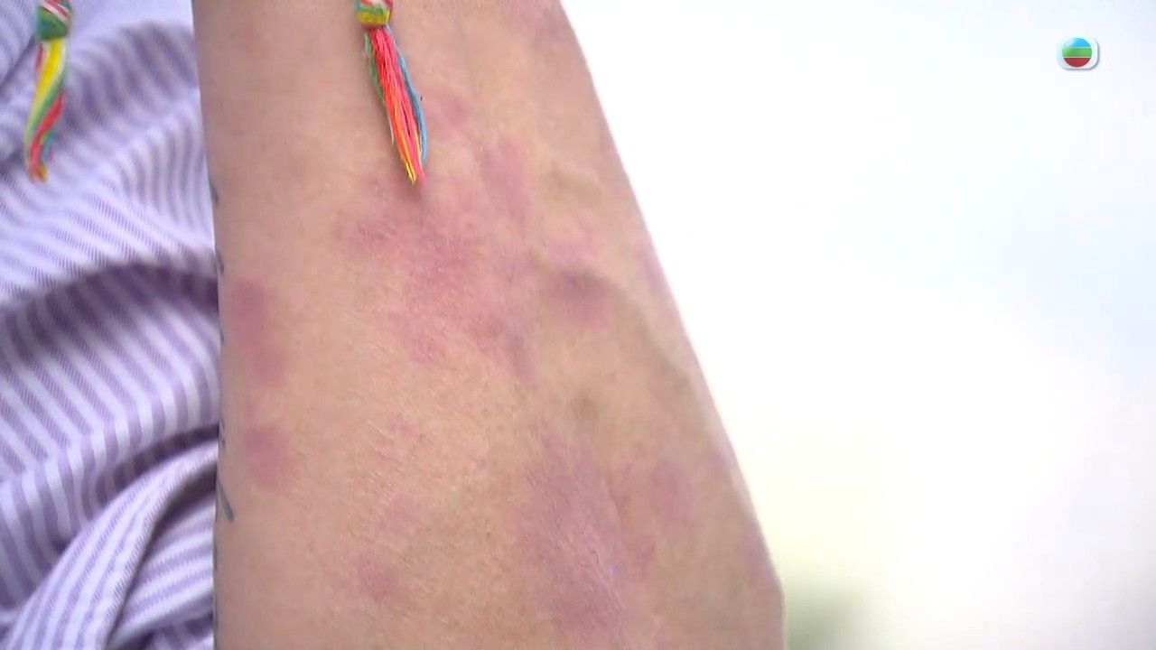 牛皮癬｜專科醫生拆解銀屑病4大成因 處理不當會變關節病！3種方法紓緩牛皮癬