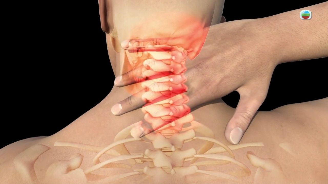 健康新聞報道｜專科醫生提醒按摩不當可致中風 30歲港人泰國按摩後出事？這2位置不能隨便按壓