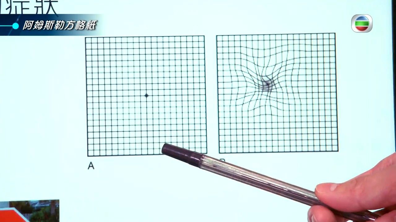 黃斑病變｜看東西扭曲是黃斑點出事？醫生教3大方法預防老年黃斑點病變 用1招檢查有無先兆