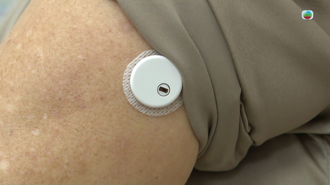 糖尿病｜長期血糖過高或致腎臟病變！醫生提醒糖尿病人小心腎衰竭！即睇糖尿腎4大徵狀