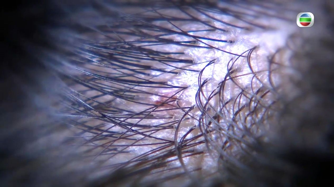 頭瘡｜專家親解生頭瘡6大成因 中醫推介一款茶飲消炎清熱 教你洗頭6個秘技