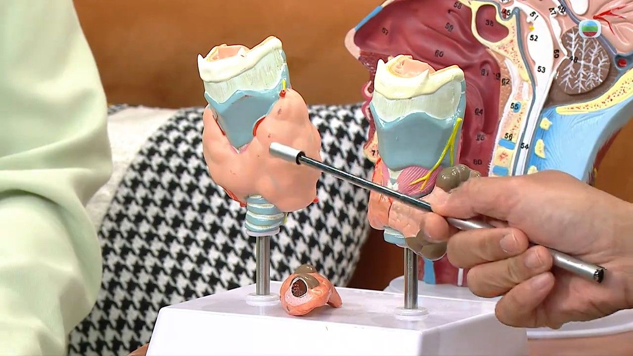 甲狀腺癌｜聲沙可能患甲狀腺癌！醫生拆解6大病徵！怎樣區分甲狀腺結節、甲狀腺癌？