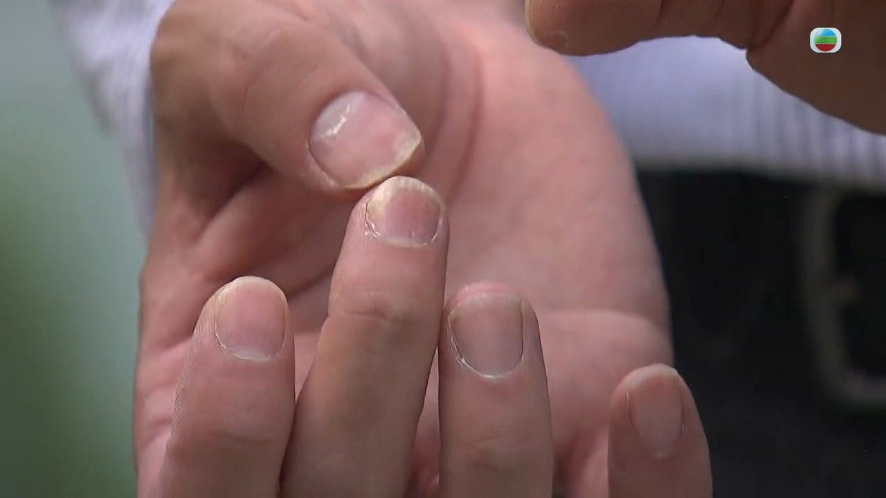 牛皮癬｜專科醫生拆解銀屑病4大成因 處理不當會變關節病！3種方法紓緩牛皮癬