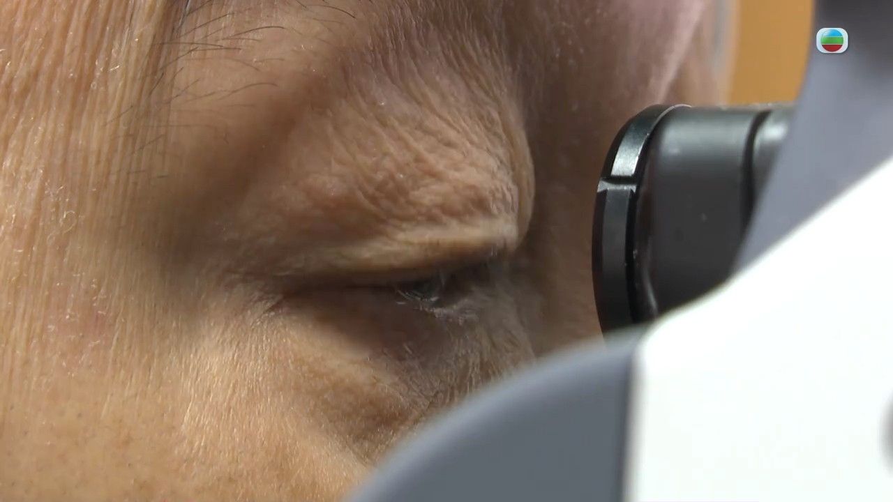 白內障｜視力模糊小心白內障！醫生警告嚴重可致2大眼疾 即睇治療方法/中醫穴位按摩