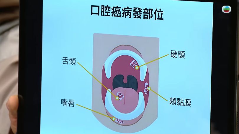 口腔癌｜牙科醫生拆解口腔癌9大高危因素 口腔不明疼痛＋白斑要小心！一種重要方法預防口腔癌