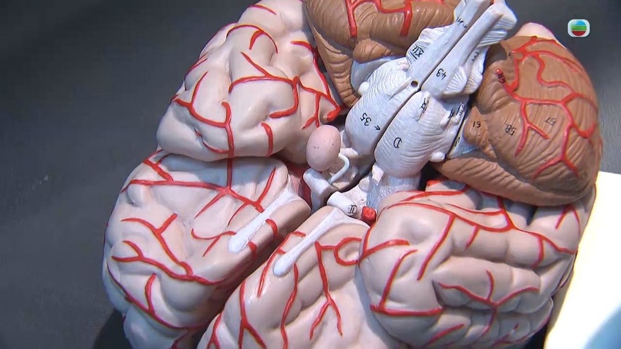 頭痛｜劇烈頭痛小心是腦血管瘤破裂！專科醫生拆解腦動脈瘤影響/檢查/手術方法