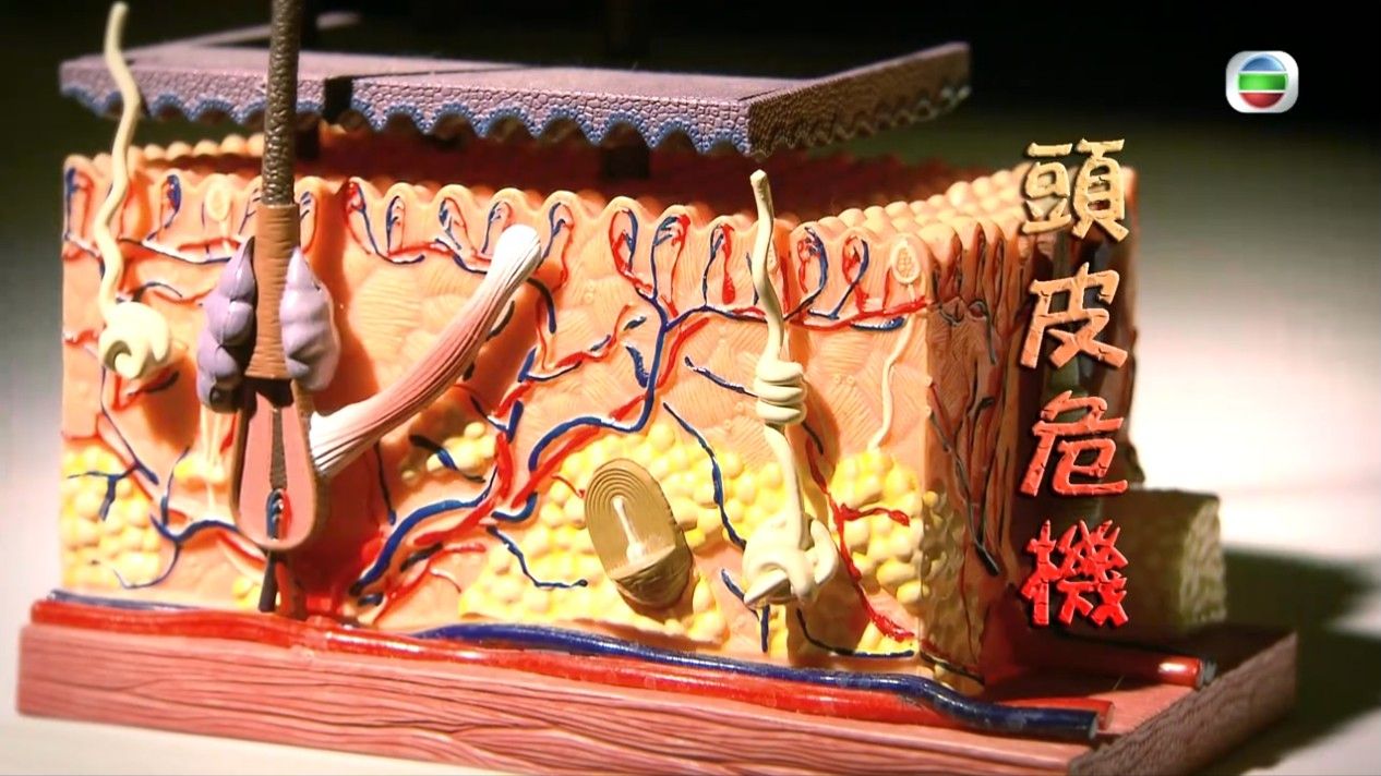 頭瘡｜專家親解生頭瘡6大成因 中醫推介一款茶飲消炎清熱 教你洗頭6個秘技