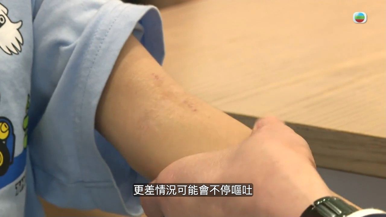 風癩｜醫生解構3種人較易患上蕁麻疹！一文睇晒蕁麻疹成因/治療方法/飲食建議